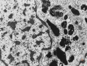 M,6m. | maxilla - melanotic progonoma (melanotic neuroectodermal tumor of infancy) M,6m. | maxilla - melanotic progonoma (melanotic neuroectodermal tumor of infancy)